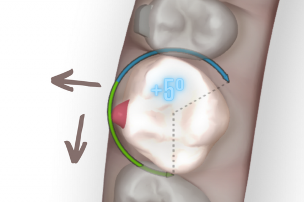 hipercorrección y sobrecorrección Orthoclub academy