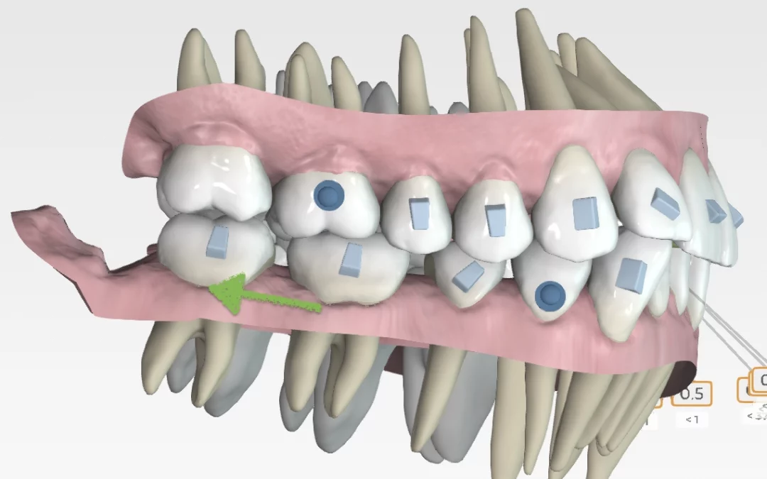 Compensación de Clase III esqueletal con alineadores invisibles: fundamentos básicos