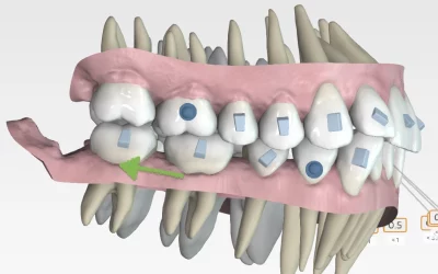 Compensación de Clase III esqueletal con alineadores invisibles: fundamentos básicos