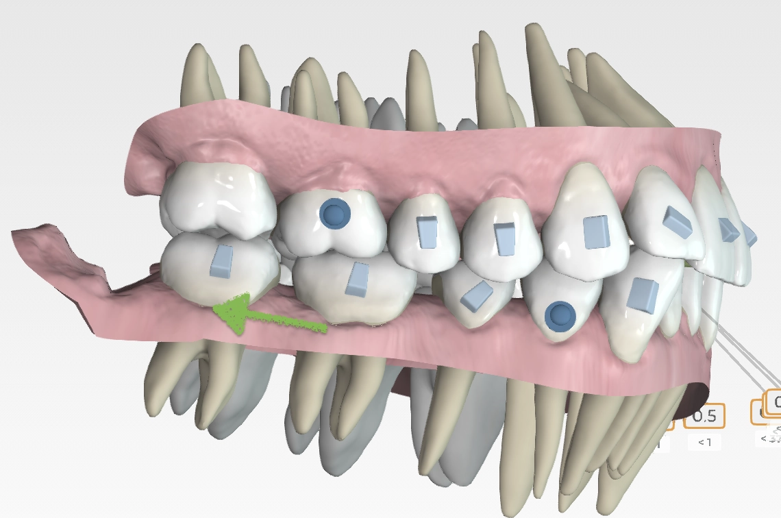 Compensación de Clase III esqueletal con alineadores invisibles