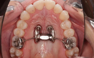 MARPE y alineadores: todo lo que debes saber para una correcta planificación