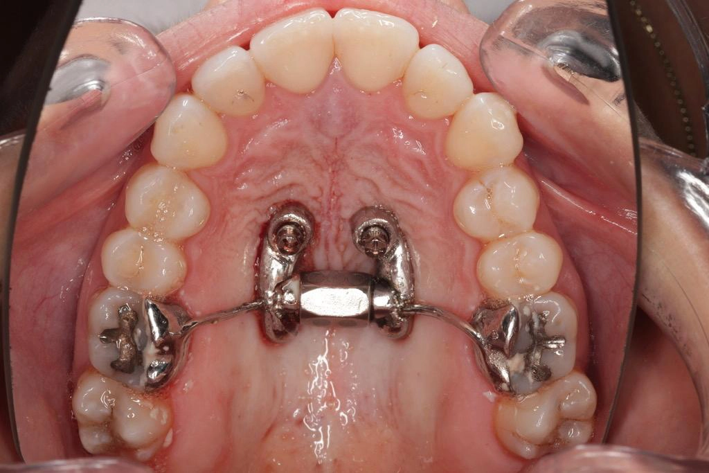 MARPE y alineadores, todo lo que debes saber para una correcta planificación MARPE y alineadores, todo lo que debes saber para una correcta planificación