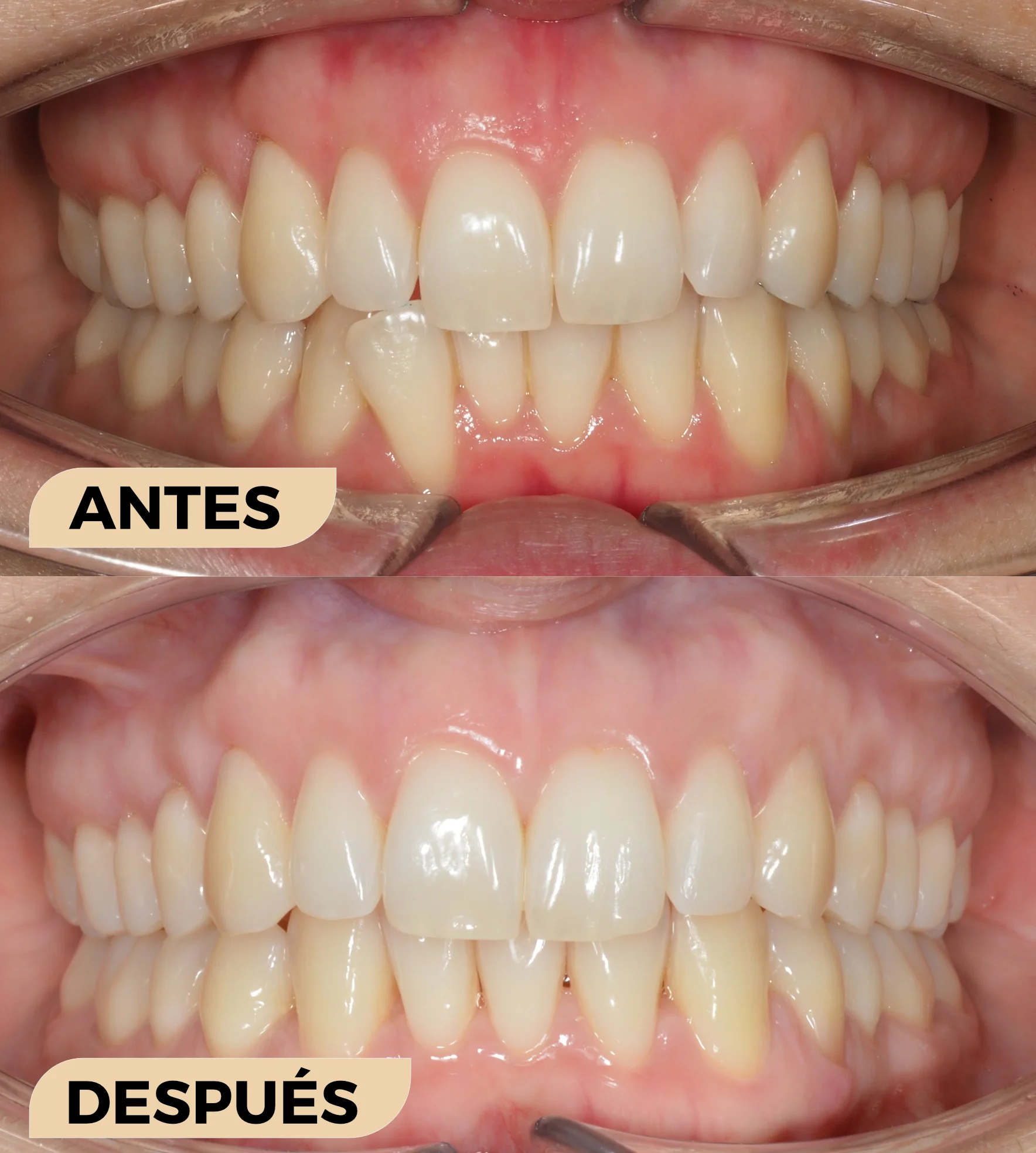 Extracción de incisivo inferior en adulto con alineadores Extracción de incisivo inferior en adulto con alineadores