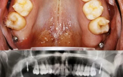 Anclaje directo e indirecto en ortodoncia: diferencias y aplicaciones con alineadores