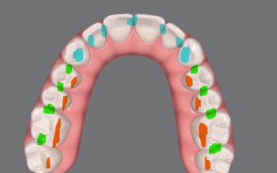 Tallado selectivo tras alineadores: qué ajustar, qué evitar y cómo mejorar el asentamiento oclusal