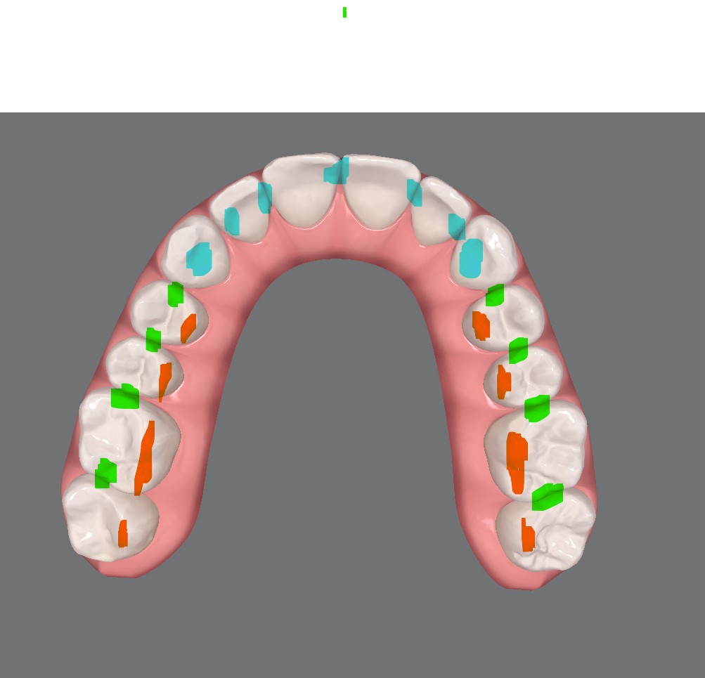 Tallado selectivo tras alineadores zonas indicadas y zonas a evitar Tallado selectivo tras alineadores zonas indicadas y zonas a evitar