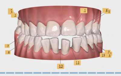 Ortodoncia invisible en pacientes periodontales: biomecánica, control y claves clínicas