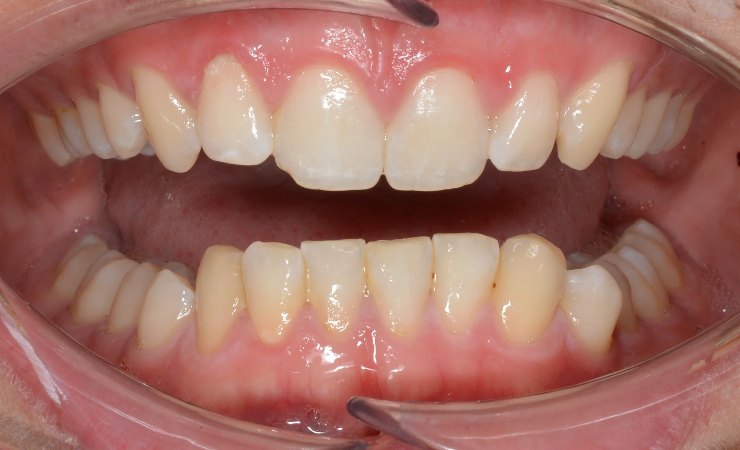 Fotografía intraoral frontal de un caso con curva de Spee inferior aumentada