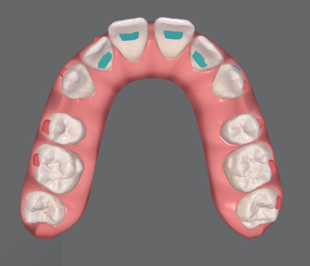 Vista oclusal en 3D de una arcada con alineadores durante el cierre de espacios de extracción